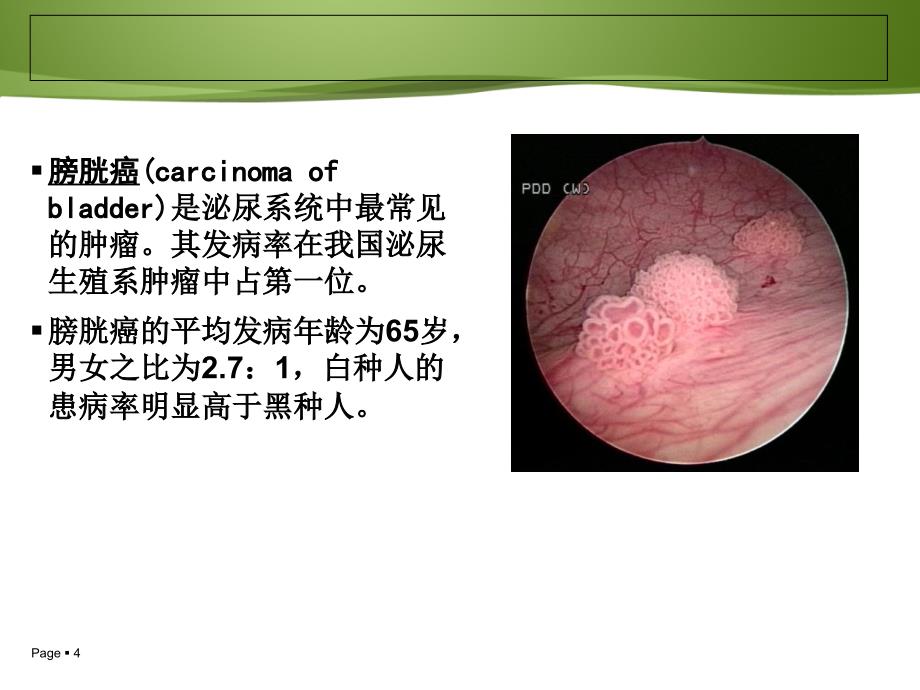 膀胱癌病人的护理及健康教育_第4页