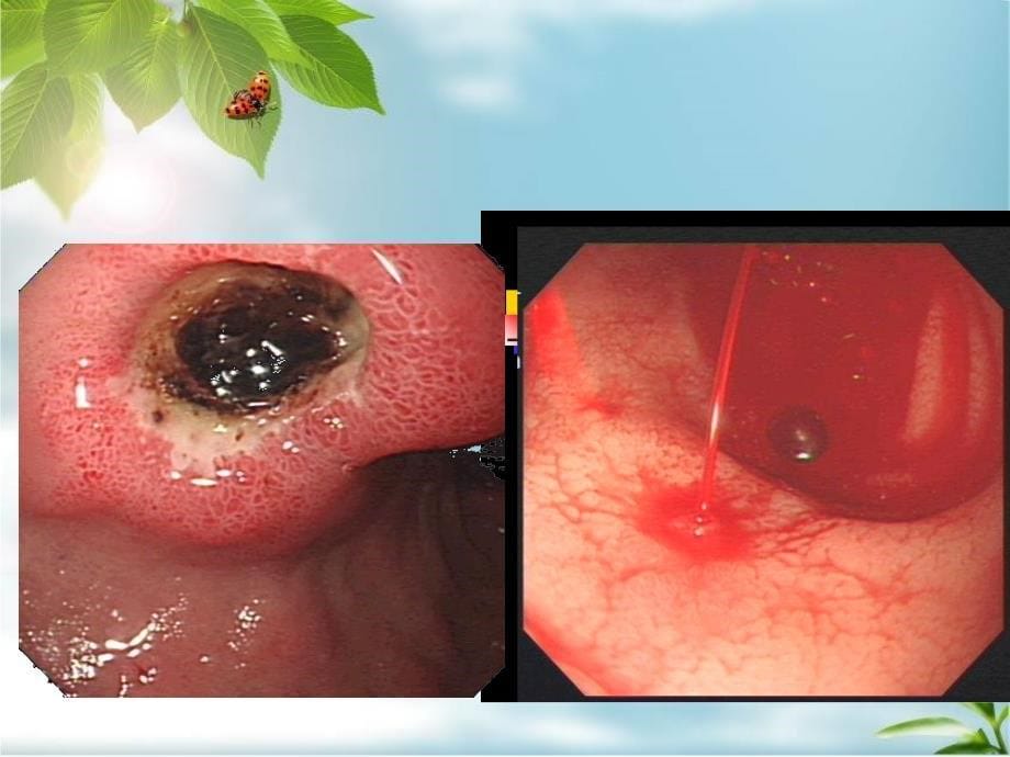 上消化道出血课件_第5页
