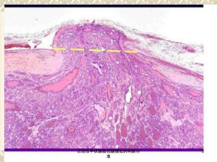 滤泡性甲状腺癌包膜侵犯的判断标准课件_第5页