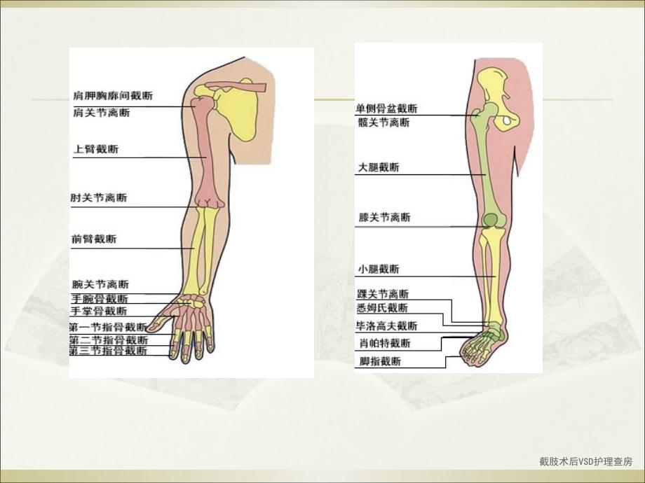 最新截肢术后VSD护理查房_第3页