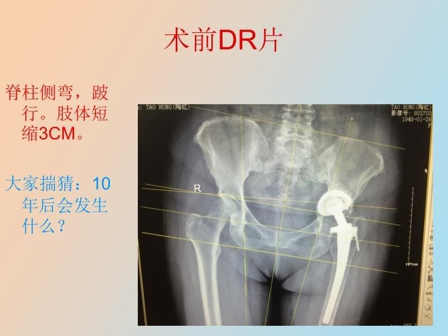 髋关节二次翻修及膝关节置换_第5页