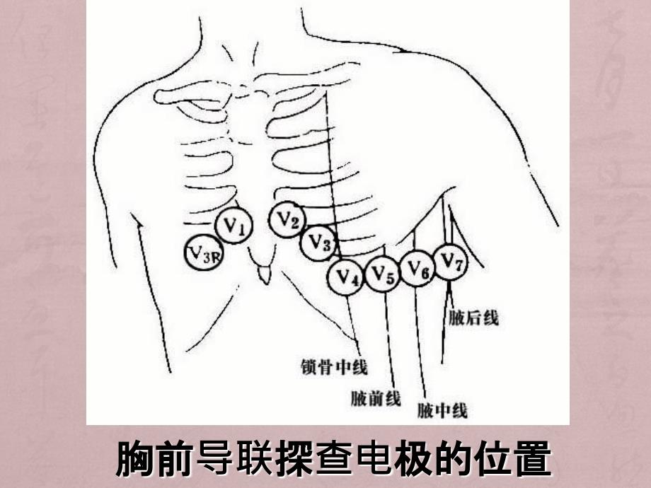 异常心电图图谱_第4页