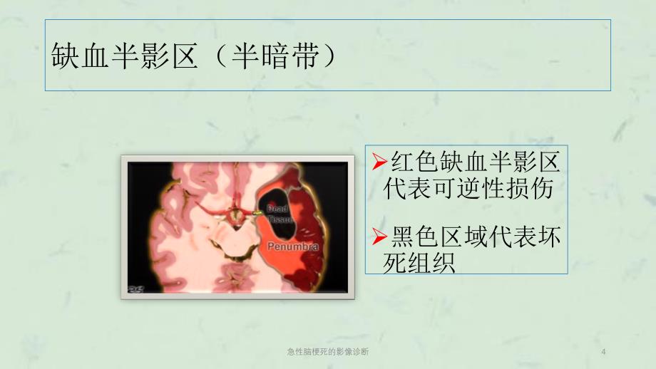 急性脑梗死的影像诊断课件_第4页