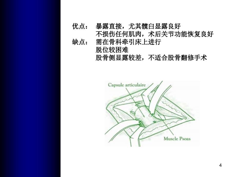 全髋关节置换手术入路文档资料_第4页