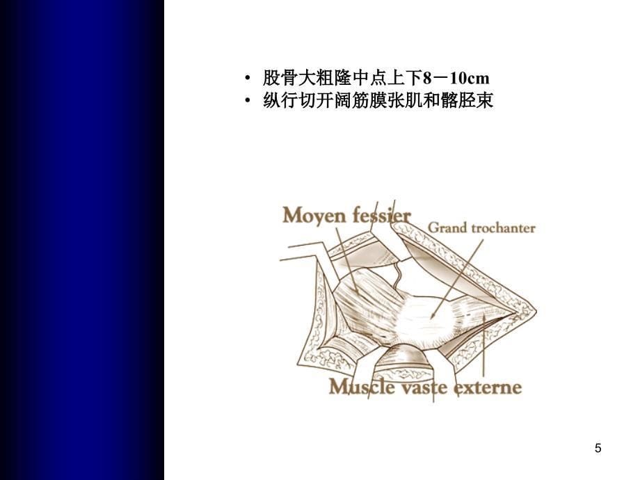 全髋关节置换手术入路文档资料_第5页