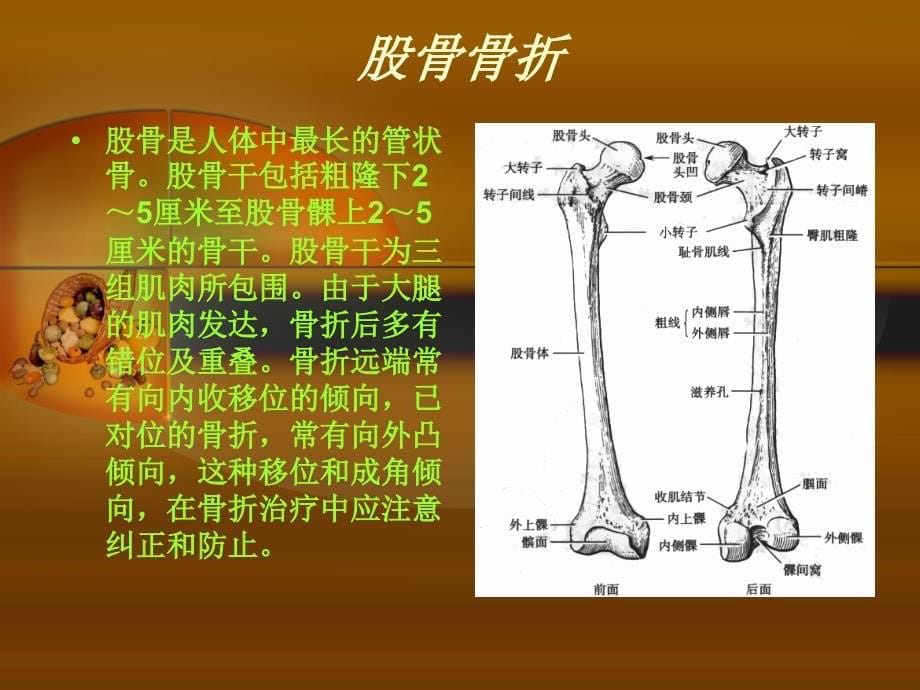 股骨干骨折护理查房-周玲玲_第5页