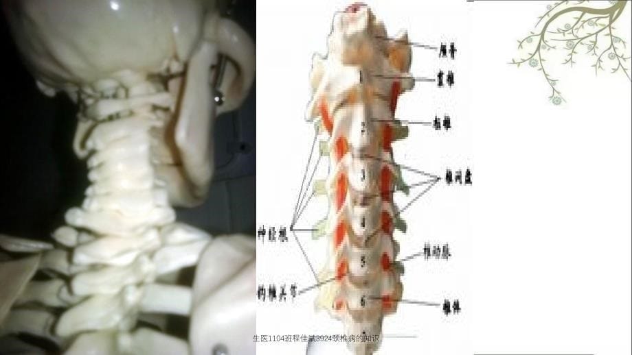 生医1104班程佳斌3924颈椎病的知识_第5页