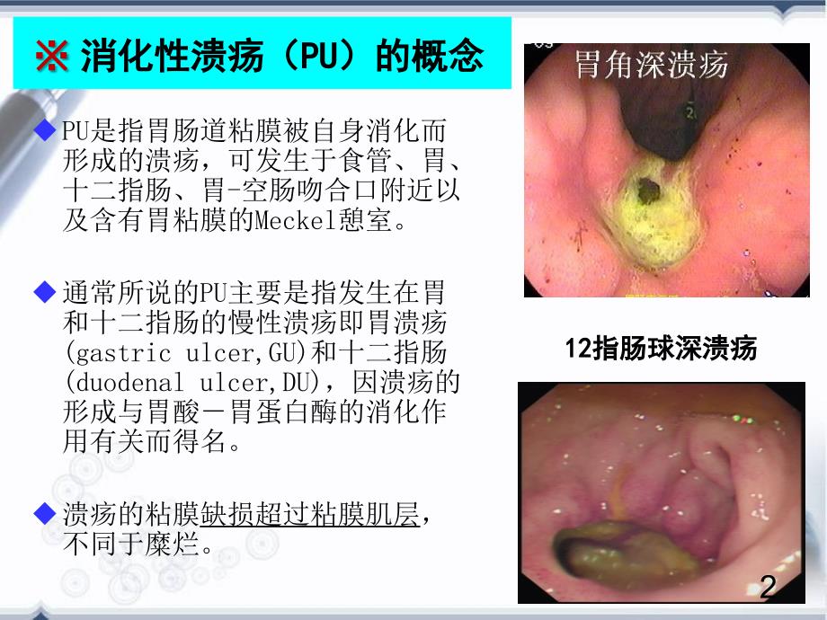 内科学：消化性溃疡_第2页