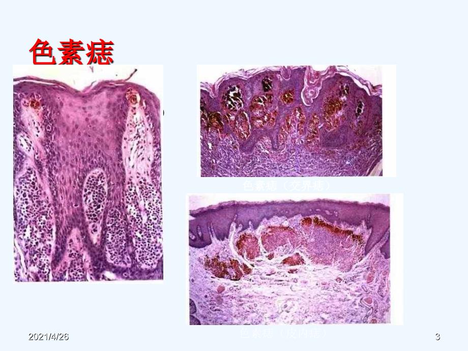 良性肿瘤和瘤样变（113页）_第3页