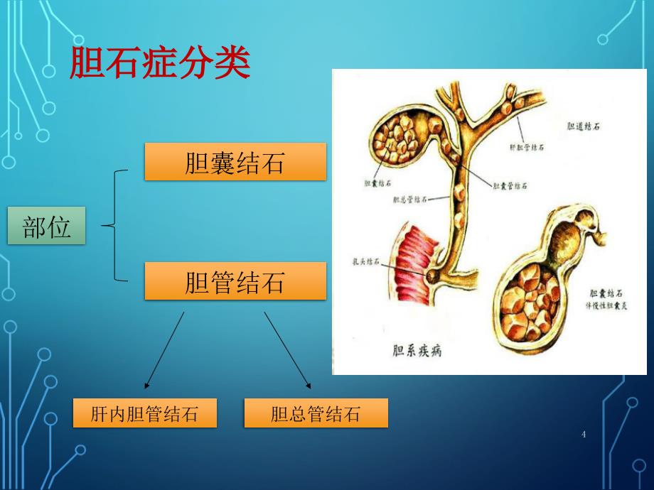 胆结石诊疗的新进展课堂PPT_第4页