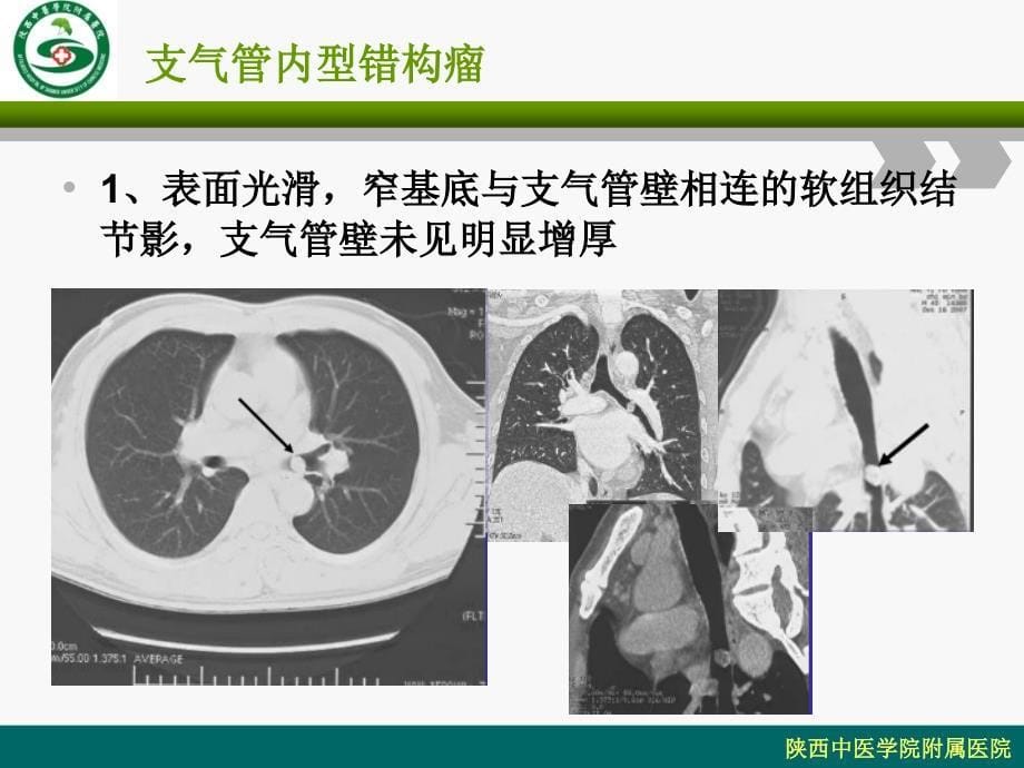 医学-肺内结节及肿块基本ct征象_第5页