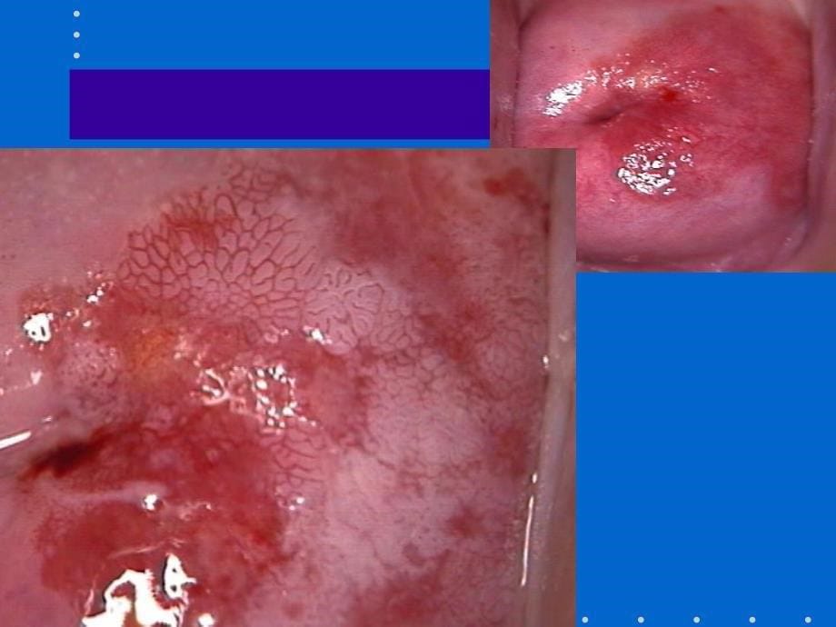 徐爱娣CIN-的诊治课件_第5页