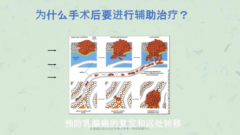 乳腺癌的综合治疗吉林大学第一医院肿瘤中心课件_第4页