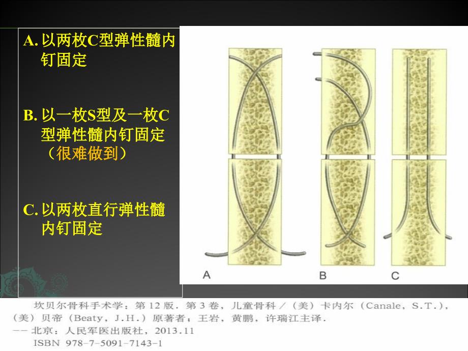 儿童长骨骨折弹性髓内钉ppt课件_第4页