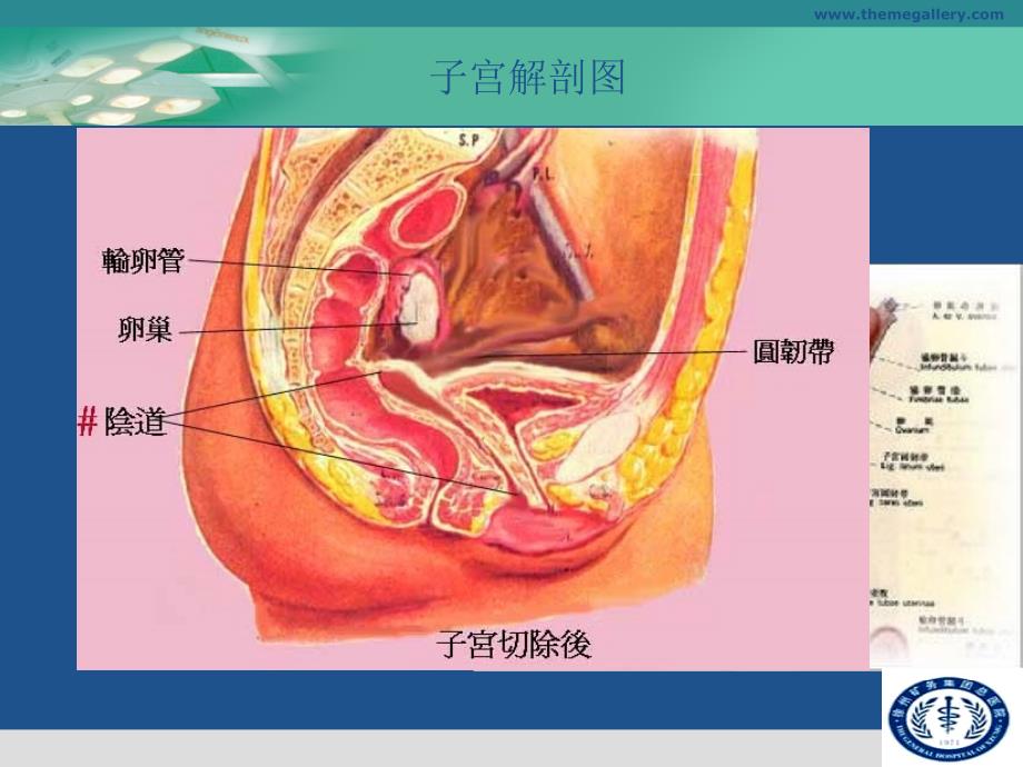 子宫全切术手术步骤_第3页