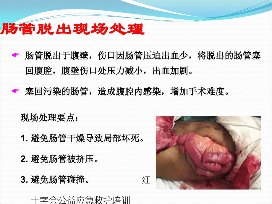 肠管脱出的应急救援原则、方法_第4页