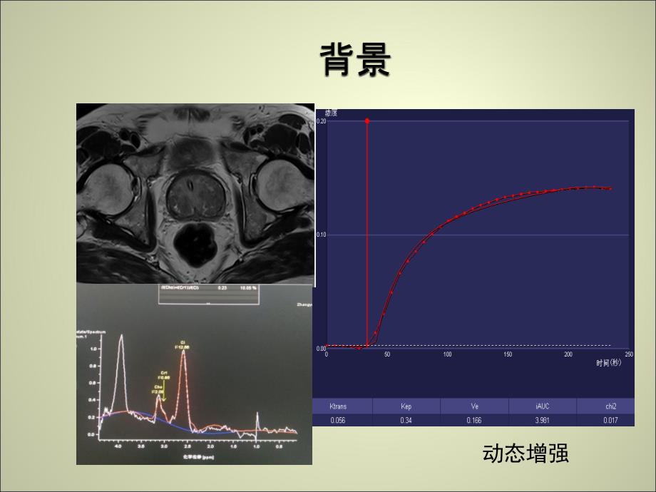 前列腺MR动态增强.ppt_第2页