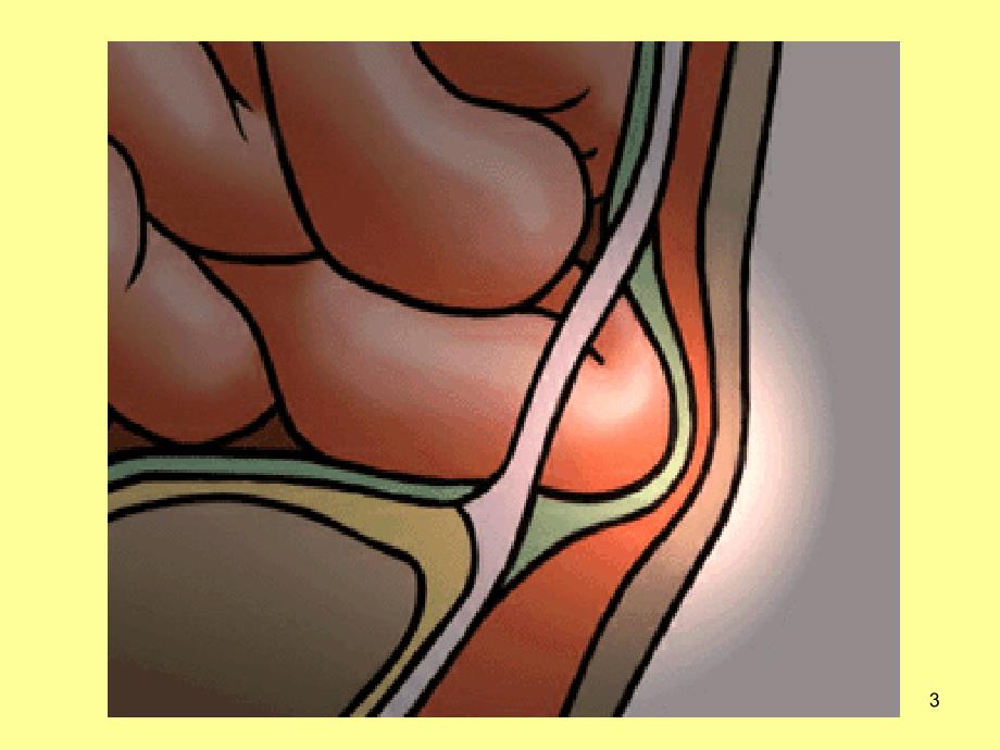 腹外疝病人的护理优秀课件_第3页