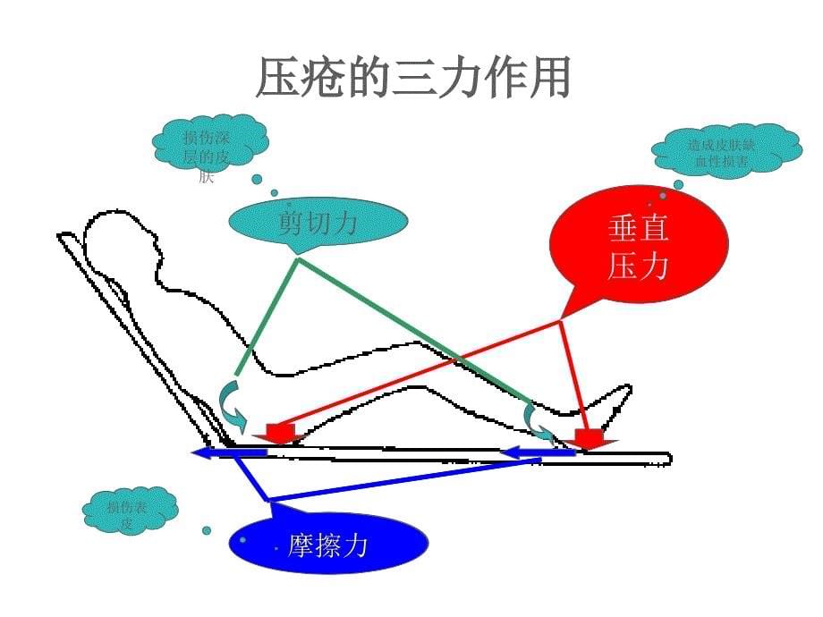 压疮相关知识课件_第5页