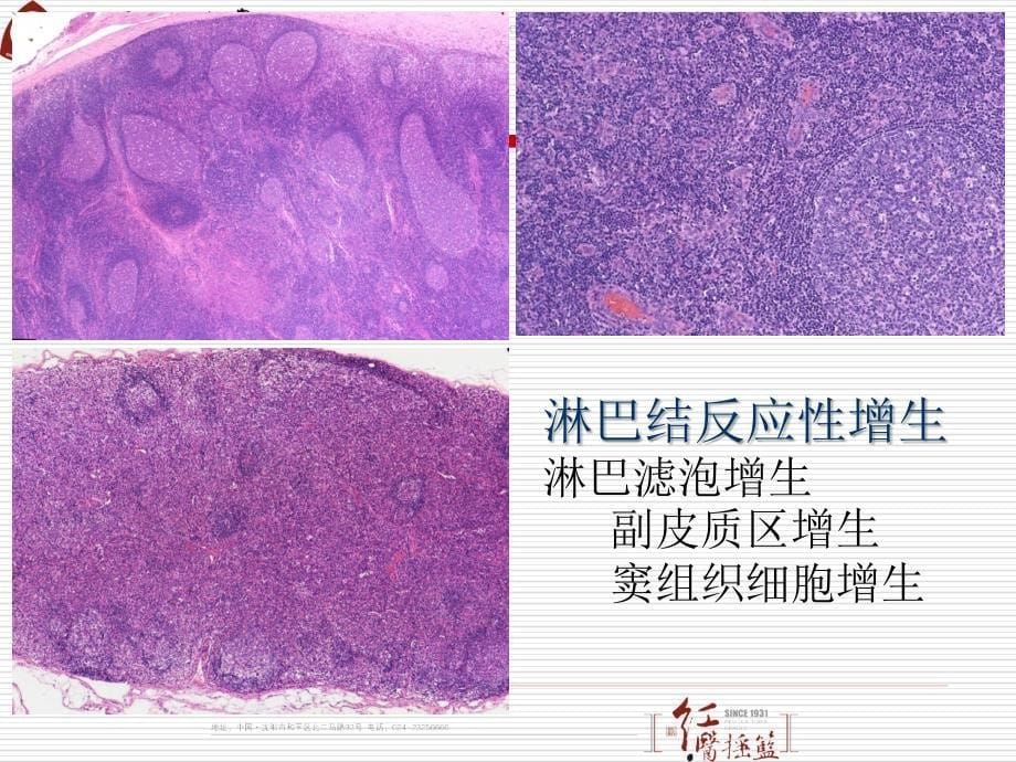 病理学课件：11 淋巴造血系统疾病_第5页