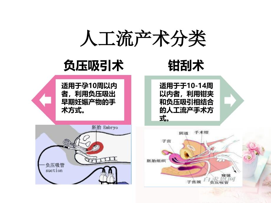 人流术后的观察与护理课件.ppt_第4页