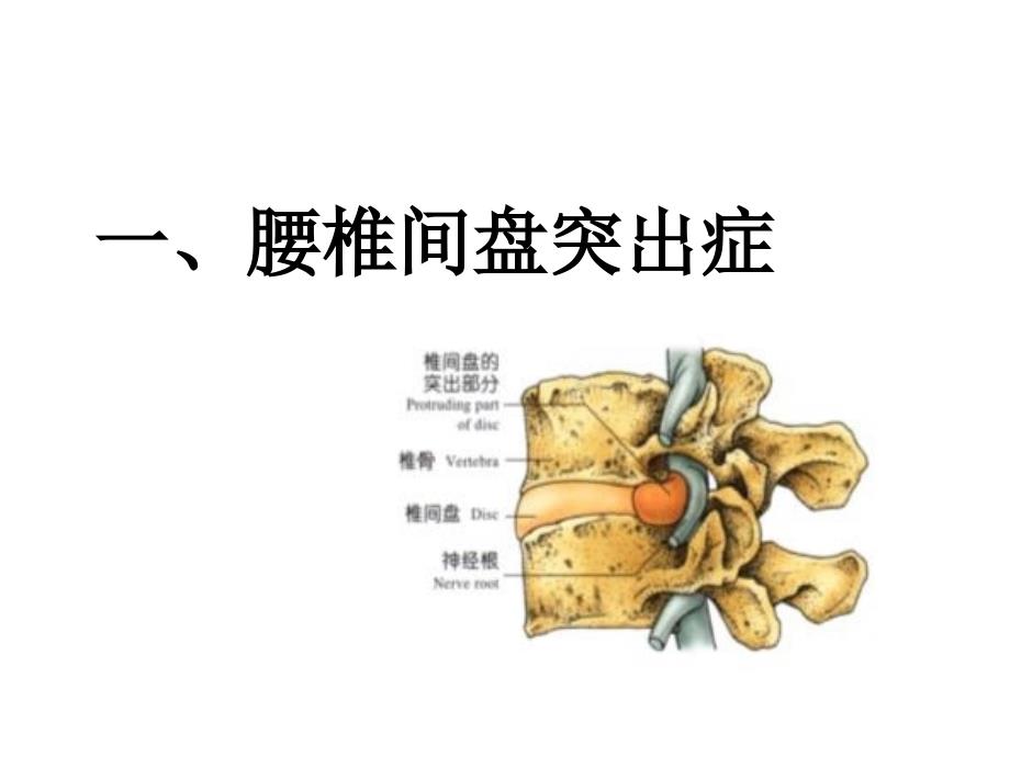 颈肩腰腿痛的护理PPT课件_第4页