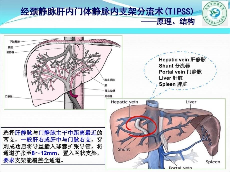 经颈静脉肝内门体分流术(TIPS).ppt_第5页