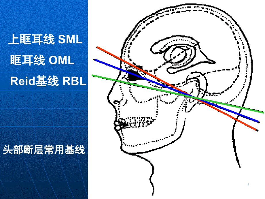 头颅CT解剖及诊断_第3页