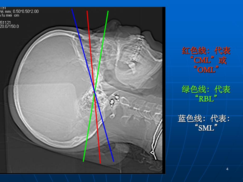 头颅CT解剖及诊断_第4页