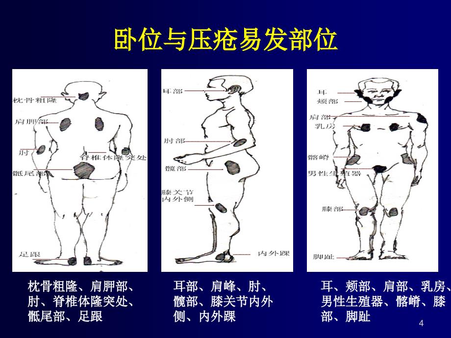 压疮预防与翻身法_第4页