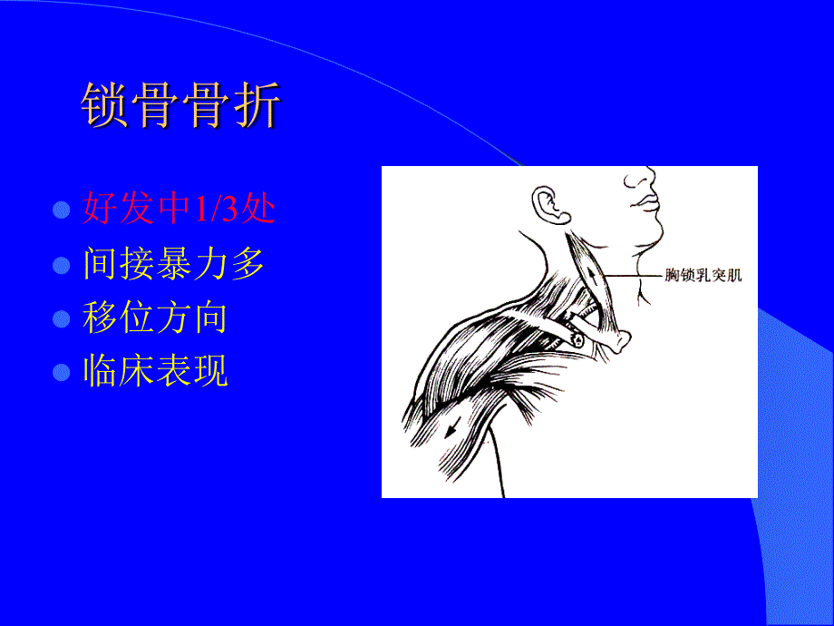 《上肢下肢骨折》PPT课件.ppt_第3页