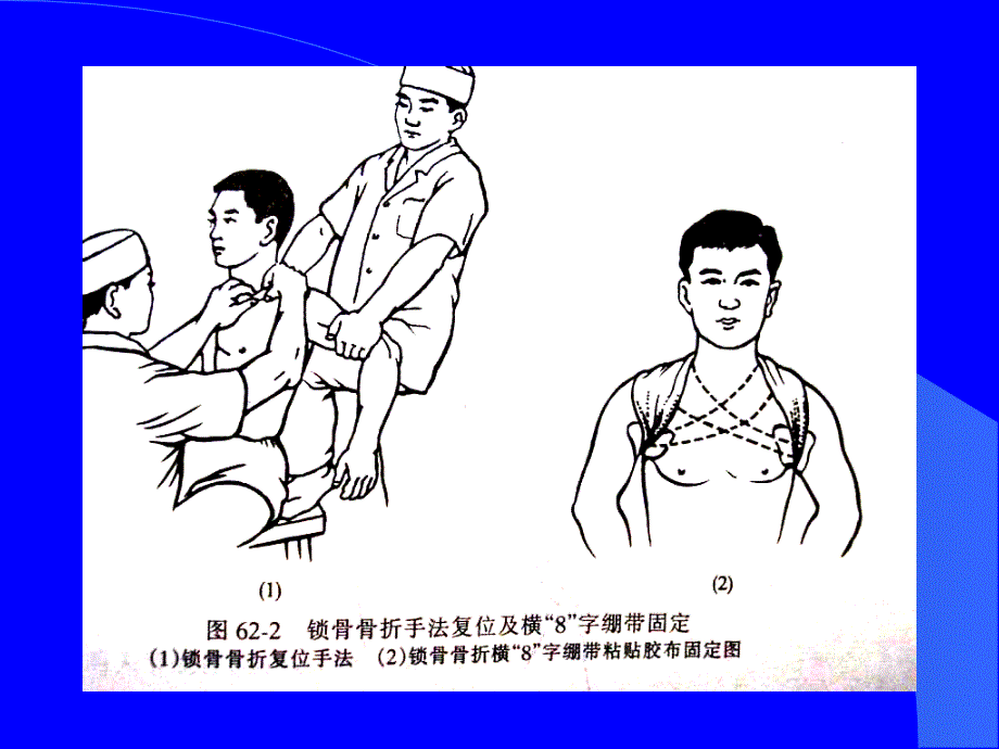 《上肢下肢骨折》PPT课件.ppt_第4页