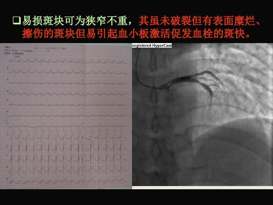 冠心病新观点及其诊断与治疗误区傅向华_第5页