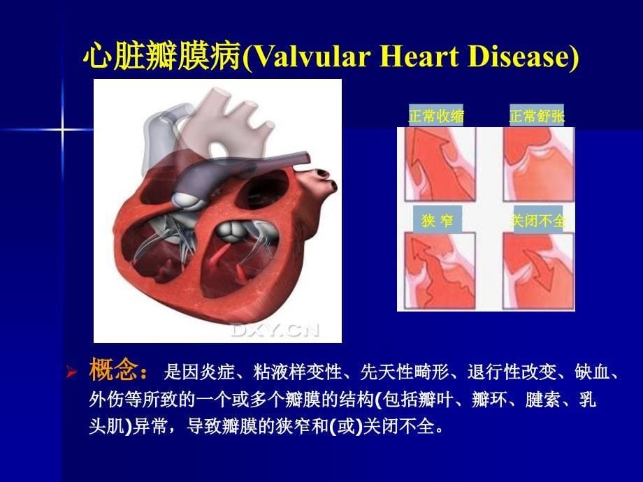 《尖瓣狭窄》PPT课件_第5页