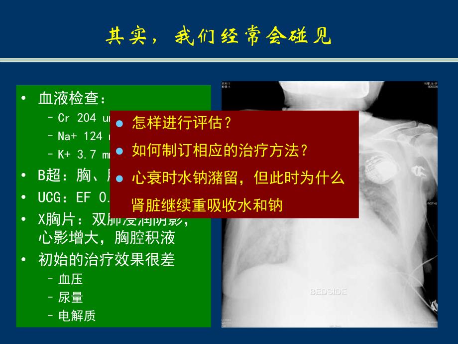 心力衰竭患者水过负荷与低钠血症课件幻灯ppt_第3页