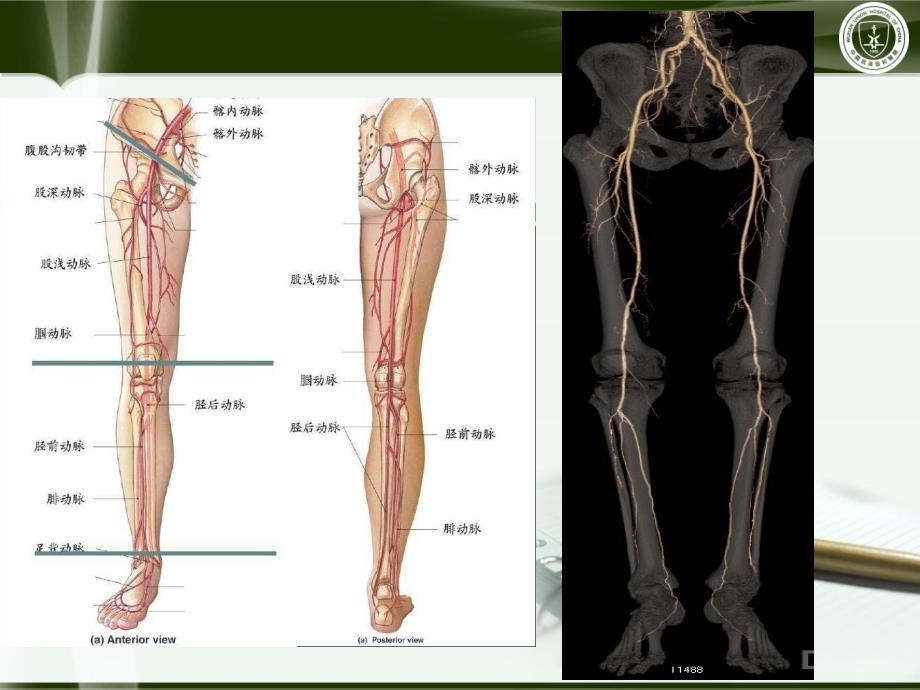 肺动脉减影cta武汉协和医院朱乐_第2页