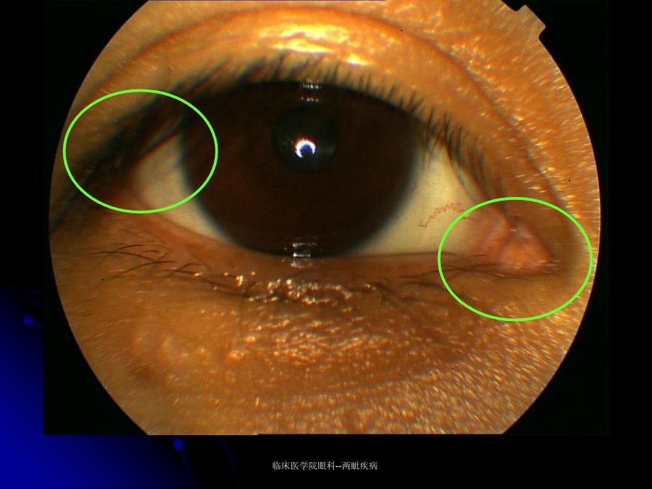 临床医学院眼科两眦疾病课件_第3页