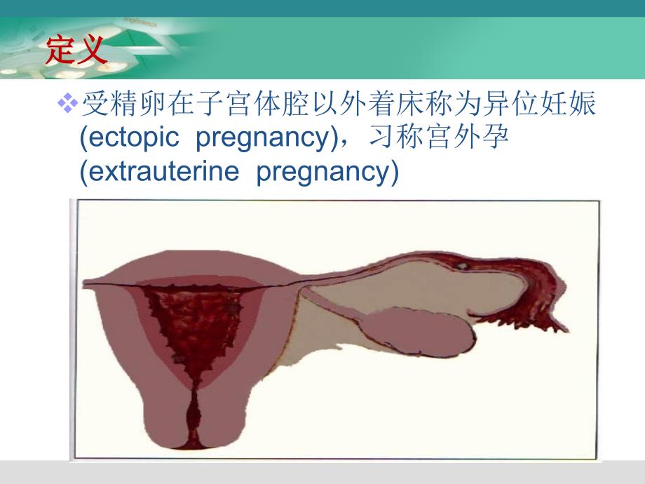 腹腔镜下宫外孕手术的护理配合PPT_第2页