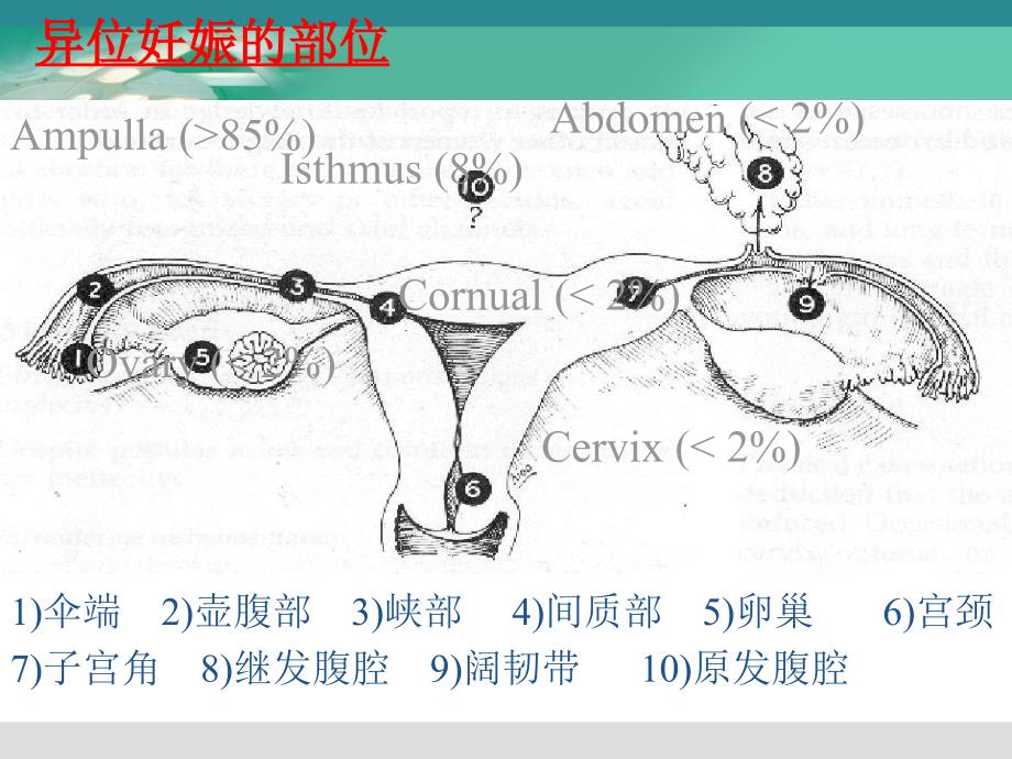 腹腔镜下宫外孕手术的护理配合PPT_第4页