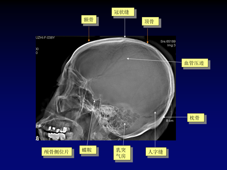 医学影像学：8中枢神经系统影像诊断_第4页