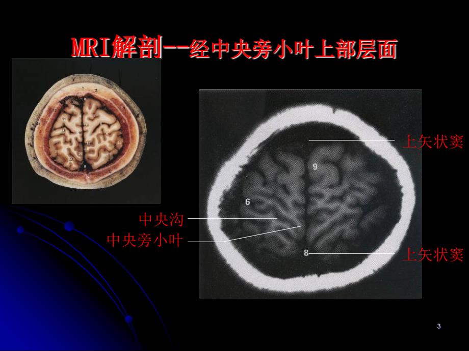 MRI基本病变影像学表现ppt参考课件_第3页