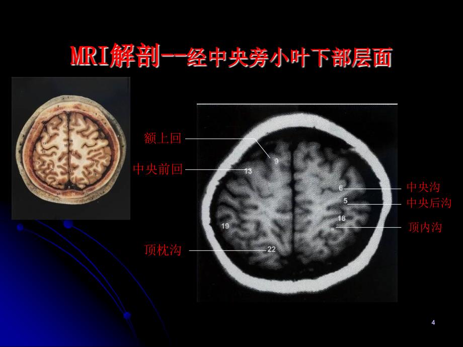 MRI基本病变影像学表现ppt参考课件_第4页