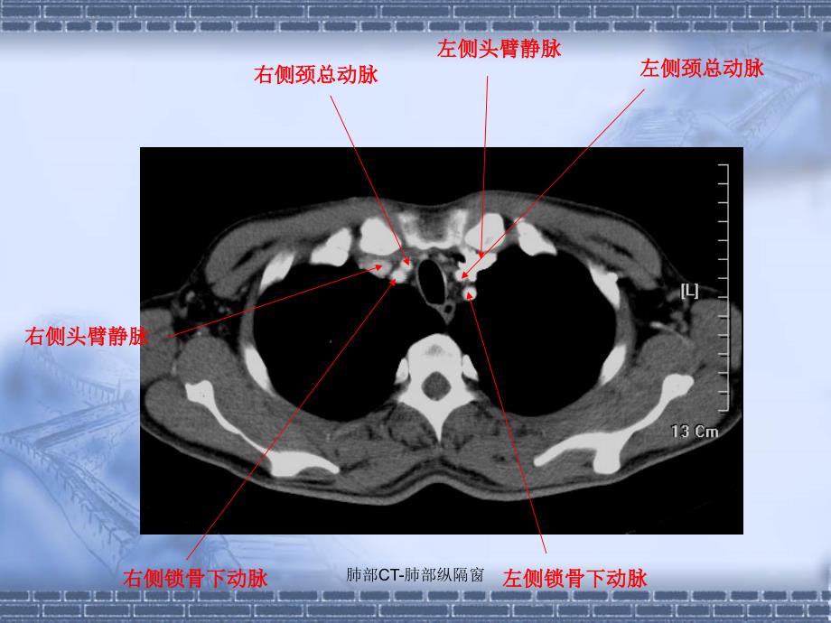 最新肺部CT肺部纵隔窗_第1页