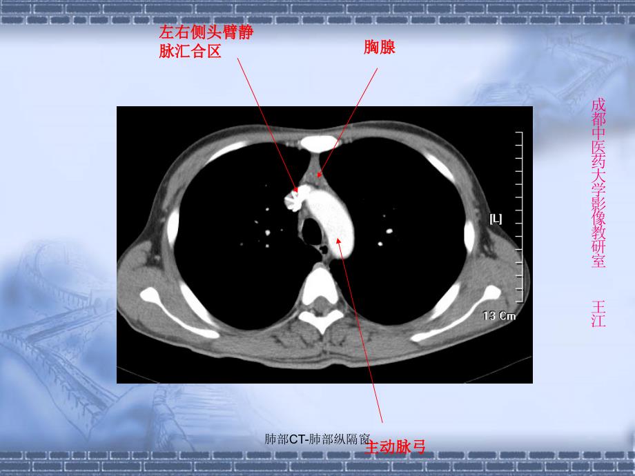 最新肺部CT肺部纵隔窗_第3页