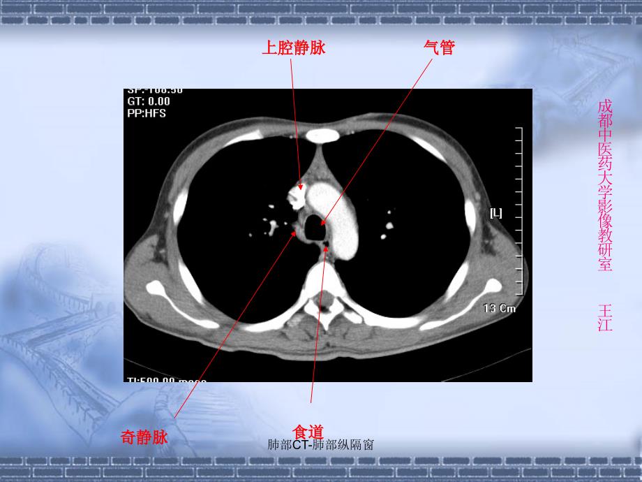 最新肺部CT肺部纵隔窗_第4页