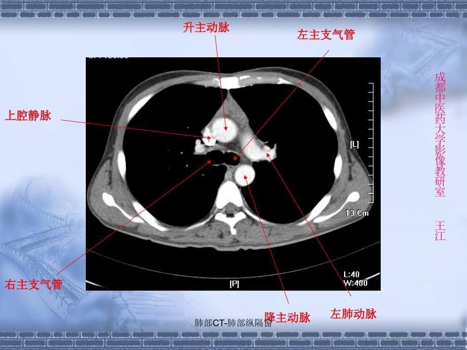 最新肺部CT肺部纵隔窗_第5页