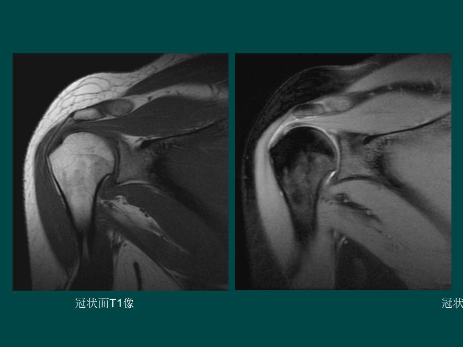 肩关节MRI检查及其常见病表现_第4页