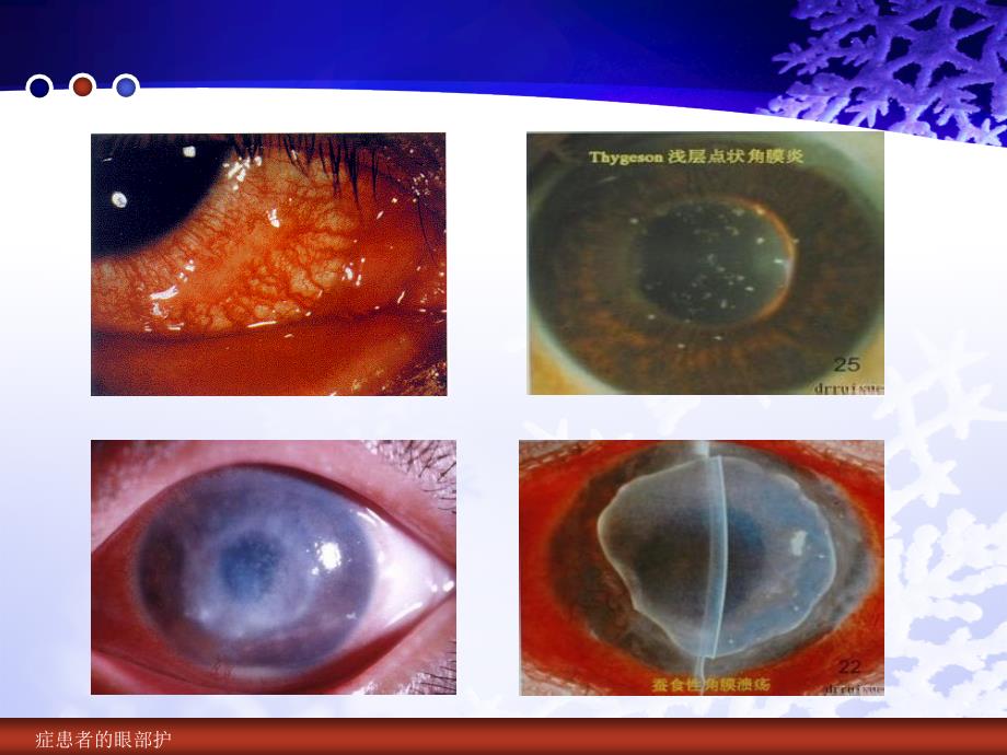 症患者的眼部护课件_第3页