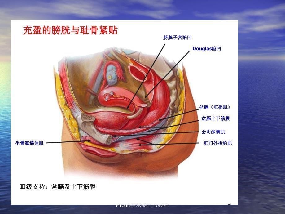 Prolift手术要点与技巧课件_第5页