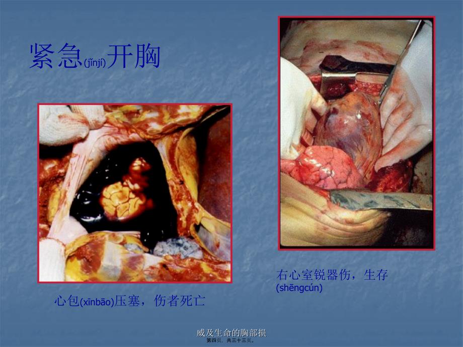 威及生命的胸部损课件_第4页